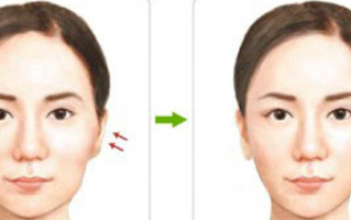 韩国面部整形价格一览表,颧骨下颌角双鄂拉皮费用都在内