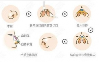 韩国TS整形外科鼻歪斜整形手术是怎么样做的非切开矫正歪鼻!