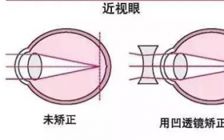 近视和远视的区别是什么？为什么会近视或者远视？有没有办法治疗？